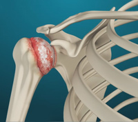 Arthritis of the Shoulder Image Arthritis of the Shoulder