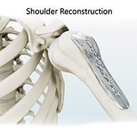 Shoulder and Elbow Image Shoulder and Elbow