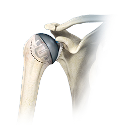 Shoulder and Elbow Image Shoulder and Elbow