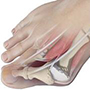 Bunion Surgery