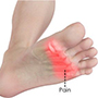 Forefoot pain