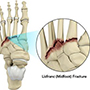 Lisfranc (midfoot) injuries