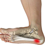 Plantar fasciitis