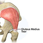 Gluteus Medium Repairs