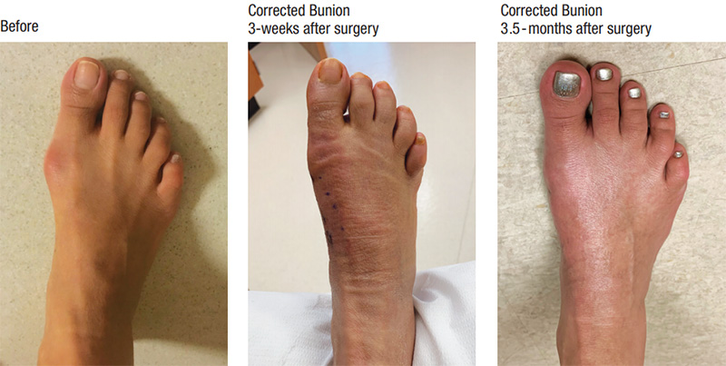 Minimally Invasive Bunion Correction