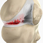 Knee Arthritis