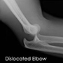 Elbow Dislocation