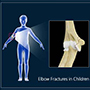   Elbow Fractures in Children