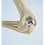 Total Elbow Replacement