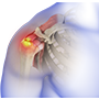 Rotator Cuff Repair