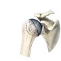 Stemless Shoulder Joint Replacement